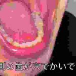 【実写】大学中退ニート、ついに虫歯ができてしまう